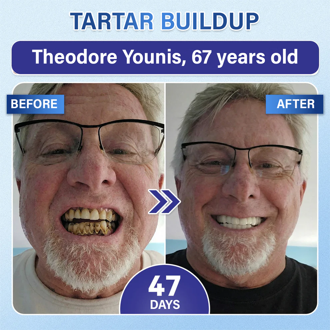 Before and after — tartar buildup