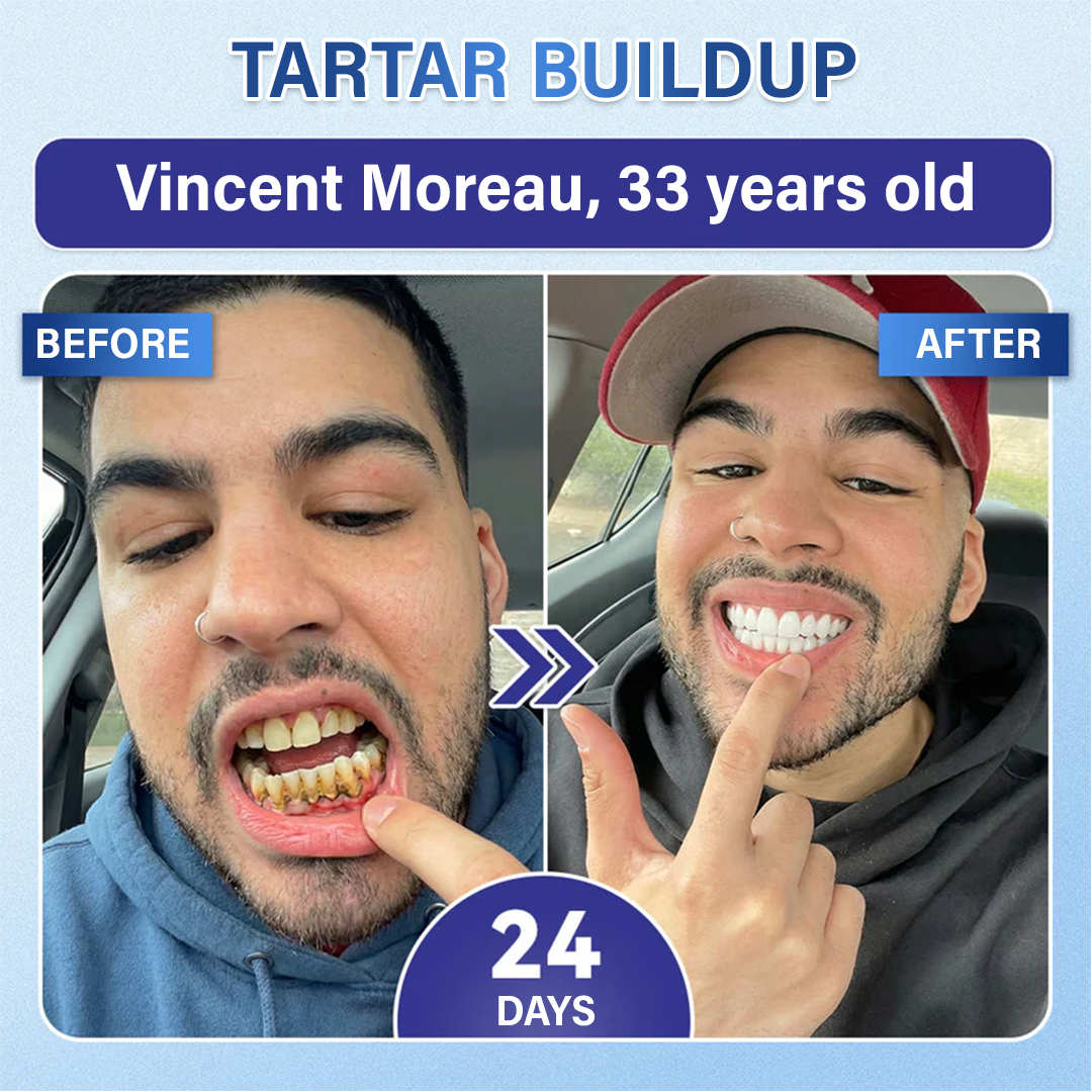 Before and after — stains and tartar